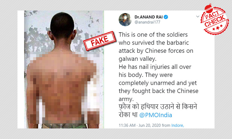 यह तस्वीर हाल में भारत-चीन स्टैंडऑफ में घायल सिपाही की नहीं है यह तस्वीर हाल में भारत-चीन स्टैंडऑफ में घायल सिपाही की नहीं है